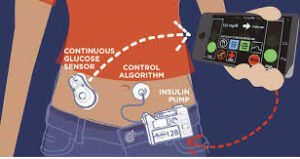 #We are not waiting - DIY APS Do-It-Yourself Artificial Pancreas Systems