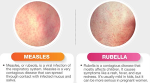 Measeles and Rubella