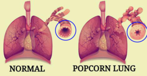normal vs Popcorn lung